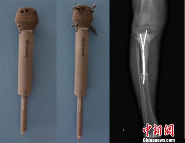 3Dプリント足の骨